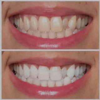 Ultraviolet Pearly White Teeth Whitening Gel
